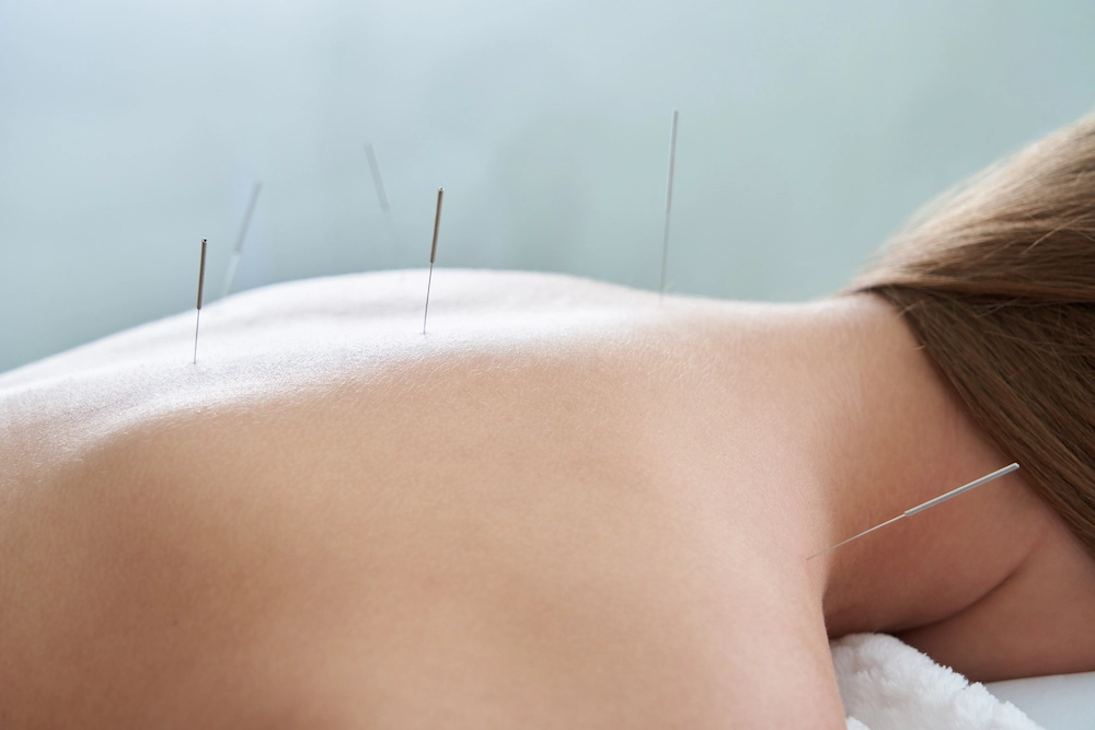 Acupuncture needles - needle insertion in the skin